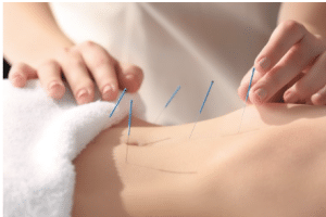 Totowa NJ - Certified Acupuncture Treatment In Totowa